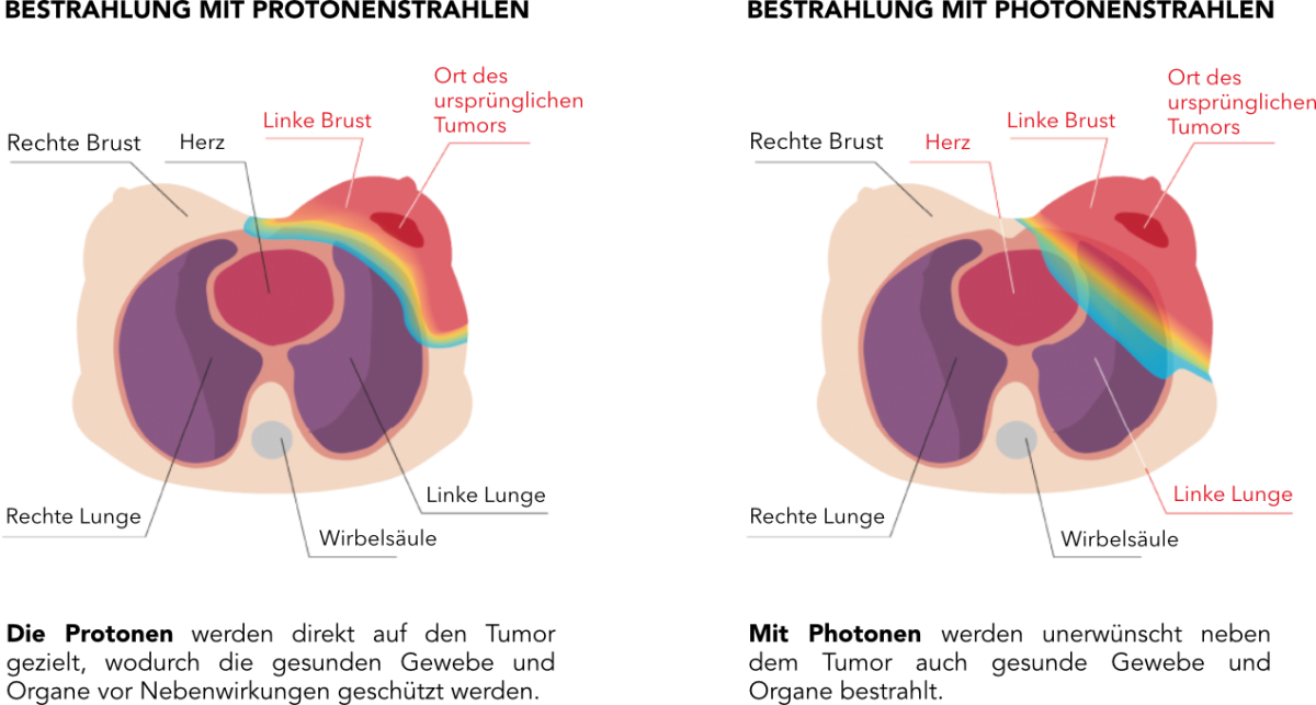 breast-protonvsphoton-de.png (306 KB)