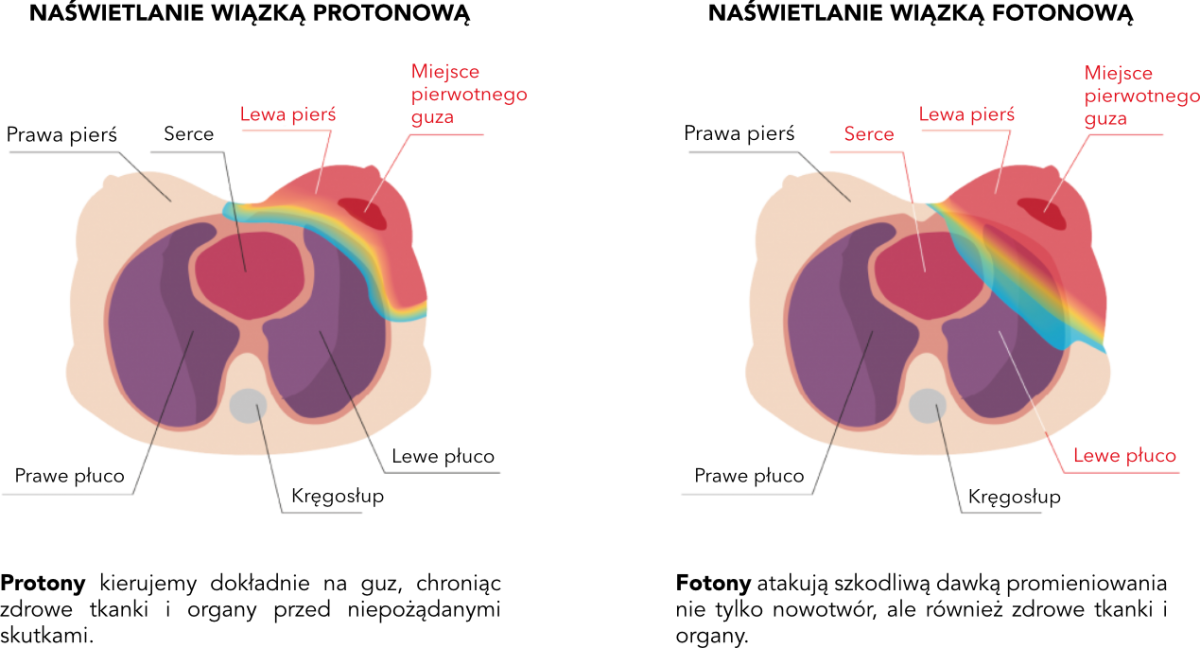 breast-protonvsphoton-pl.png (305 KB)