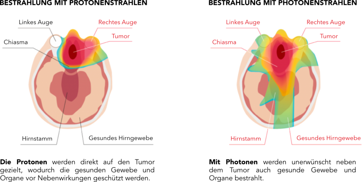 headneck-protonvsphoton-de.png (271 KB)