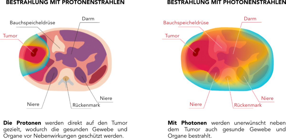 liver-protonvsphoton-de.png (304 KB)