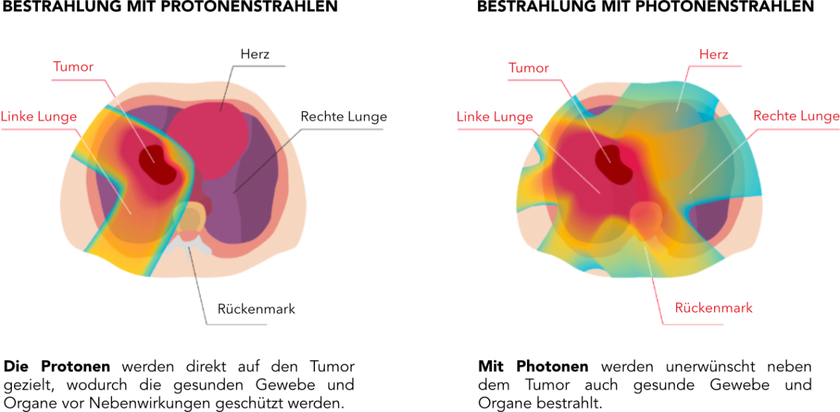 lung-protonvsphoton-de.png (284 KB)