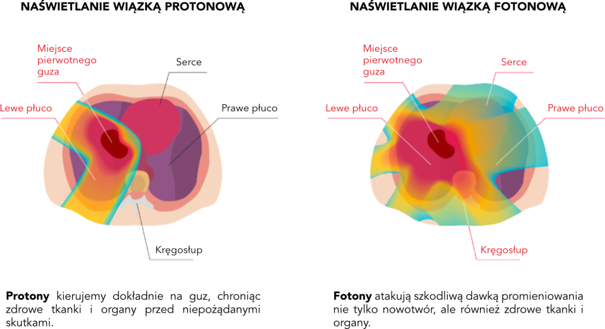 lung-protonvsphoton-pl.png (288 KB)
