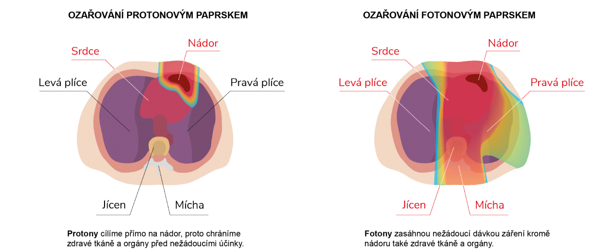 lymfom-150x.png (256 KB)