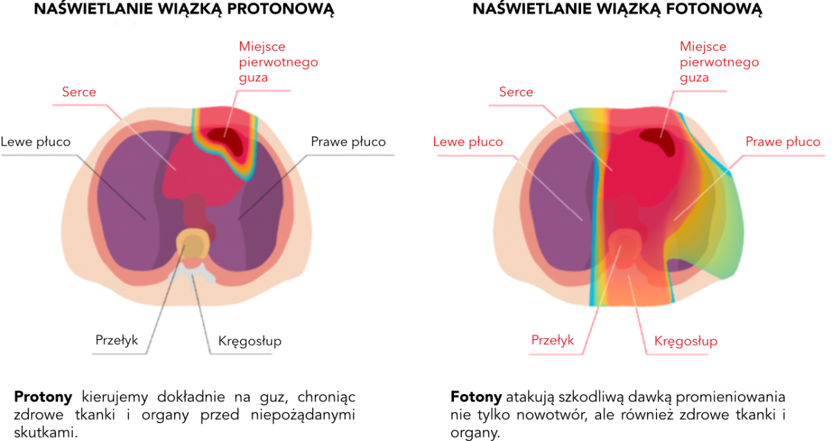 lymphoma-protonvsphoton-pl.png (286 KB)