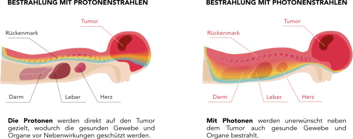 pediatric-protonvsphoton-de.png (165 KB)