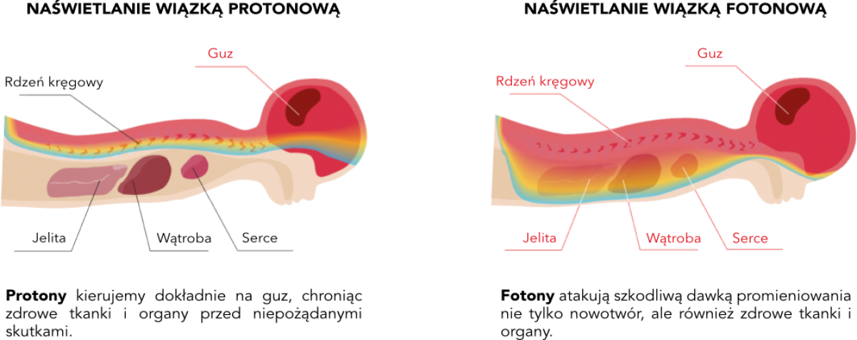 pediatric-protonvsphoton-pl.png (170 KB)