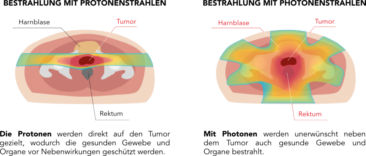 prostata-protonvsphoton-de.png (234 KB)