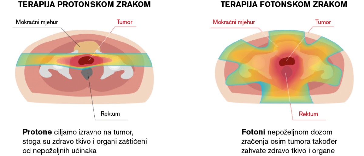 prostata-protonvsphoton-hr.png (201 KB)
