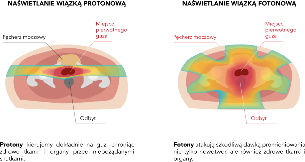 prostate-protonvsphoton-pl.png (272 KB)