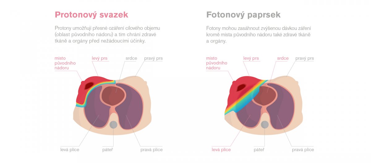 prsy-porovnani-proton-vs-foton.jpg (473 KB)